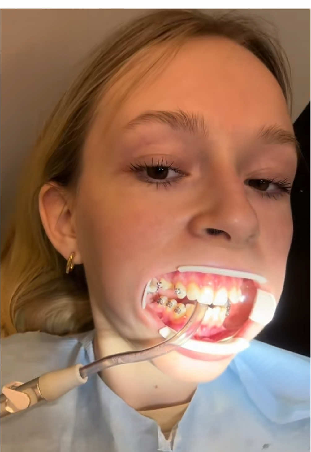 I would never EVER tell anyone to get braces. I had to remove 4 healthy teeth. The pain you feel every month for 2-3 days when you eat nothing but yogurts. Inserting a screw into your jaw hurts every day as it irritates the skin around it. You smile, you eat and it hurts 24/7. Rubber bands don't hurt, for me it's just an inconvenience. #braces #bracesguide #bracestips #bracesoff #bracesjourney 