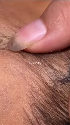 😱😱😱#omg #lice #liceremoval 