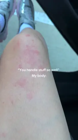 Stress hives are not for the weak 🥲 All in gods plan, he doesn’t put you through what you can’t handle! 💫🙏🏻  This happens everywhere on my body, my chest, arms, back, fingers, everywhere. I experienced this 4 years ago, and I allowed it to come back again from not breathing and taking a moment to rest. Does anyone have any recommendations or does this happen to you also when overstimulated/stressed? #stresshives #hives #MentalHealth #listentoyourbody #fyp 