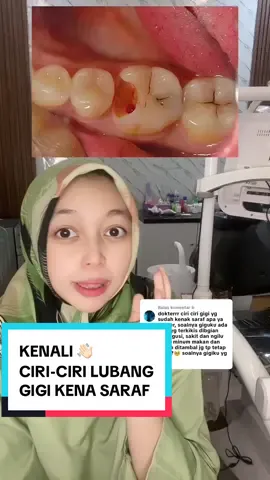 Membalas @b  ⚡ Gigi nyut-nyutan sampai bikin susah tidur? Bisa jadi saraf gigi kamu sudah terinfeksi! Ciri-cirinya antara lain: 🔹 Nyeri hebat terutama malam hari 🔹 Gigi ngilu saat kena panas/dingin lama reda 🔹 Gusi bengkak atau muncul benjolan kecil 🔹 Bau mulut tidak sedap ❗ Jangan tunggu parah. Segera periksakan ke dokter gigi sebelum infeksi menyebar. 🦷 Lebih cepat ditangani, lebih ringan perawatannya. #sakitgigi #perawatansarafgigi #gigiberlubang #psa #doktergigi 