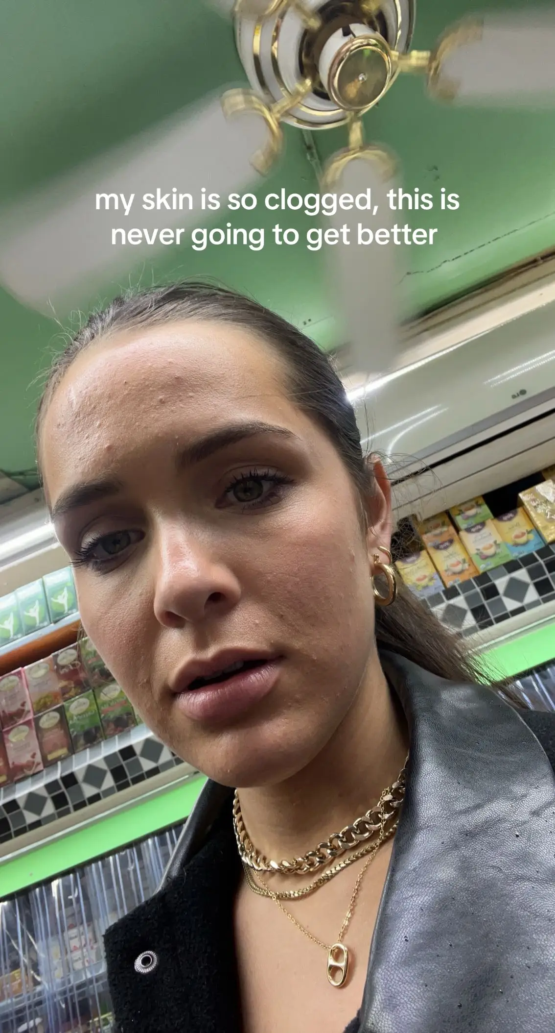 a long time coming but we made it #cloggedpores #trending #acneproneskin #acnejourney #fyp 