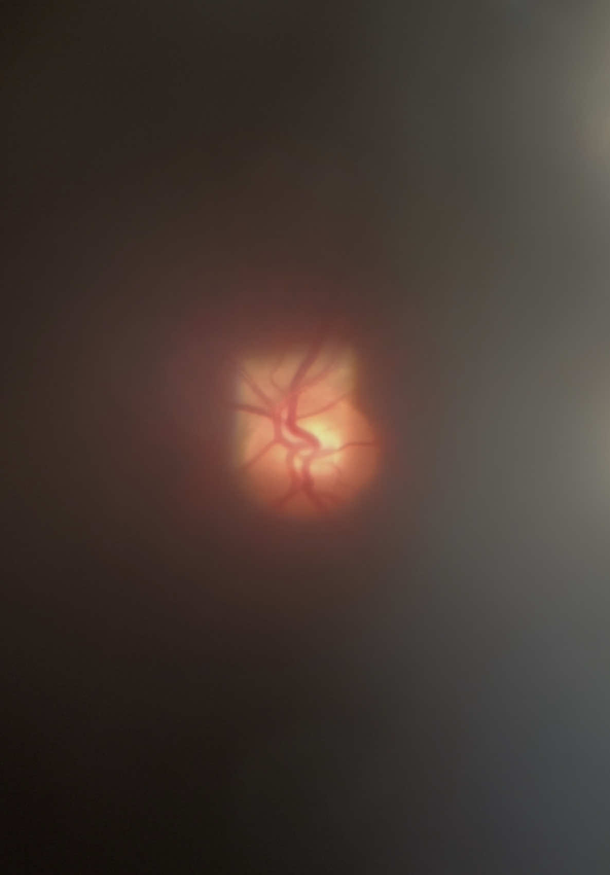 Eye doctor slit lamp POV: Healthy eyes after cataract surgery and YAG capsulotomy! #optometryasmr #medicalasmr #doctorasmr #dilation #slitlamp 