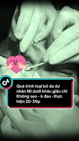 Loại bỏ da dư nhăn mí dưới sau 20-30p nhanh gọn - k đau - k sẹo - k gây ngửa mí dưới #trending #phòng_khám_thẩm_mỹ #xuhuong #mí_dưới 