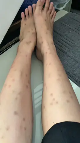 gaperlu laser mahal” #fyp #viral #bodycare #mulus #dsaviorofficial #putihbersihglowing #bekasluka #glowing #foryou #darahmanis #korengan #GlowUp 