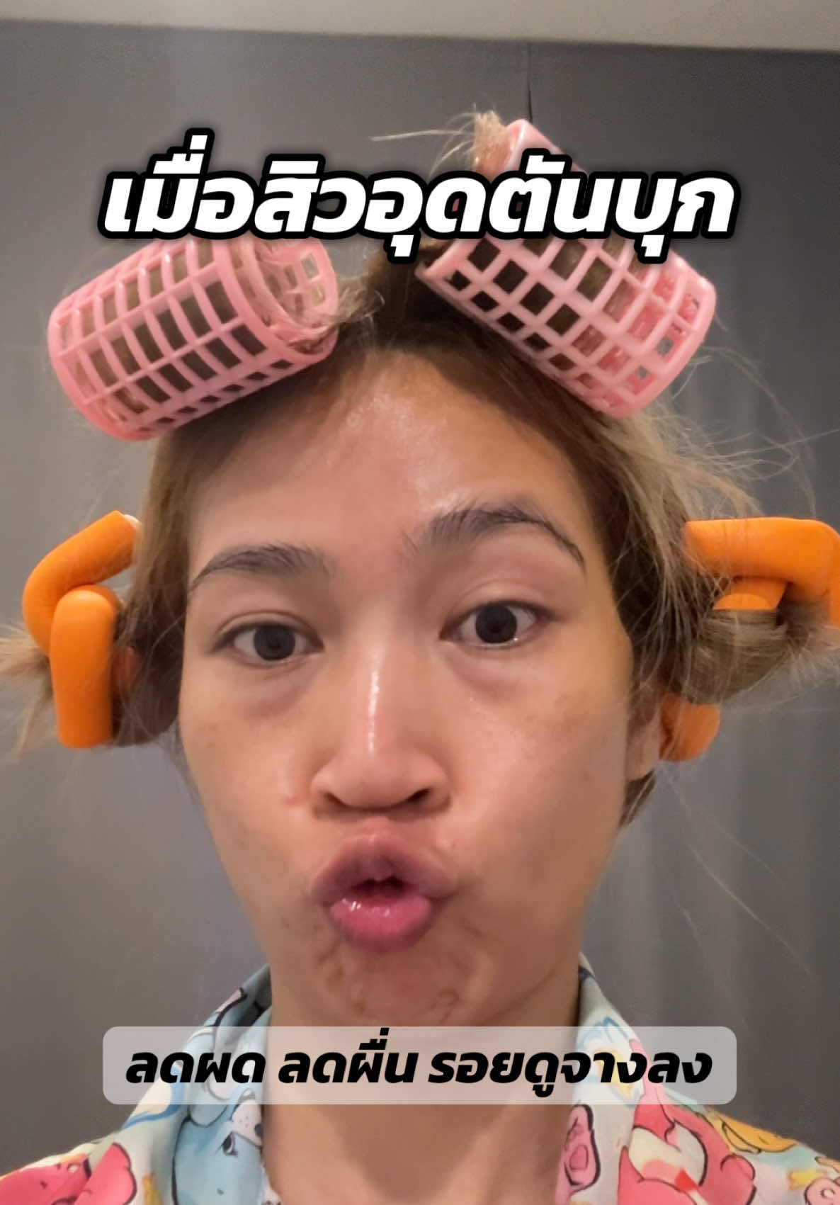 เมื่อสิวอุดตันบุก  ก็จัดเซรั่ม และน้ำตบลดสิวไปเลยจ้า ใช้เอง รีวิวเอง 👍 #ใช้ดีบอกต่อ #ใช้เองรีวิวเอง #บอกต่อ #เซรั่มลดสิว #blahmboohthailand 