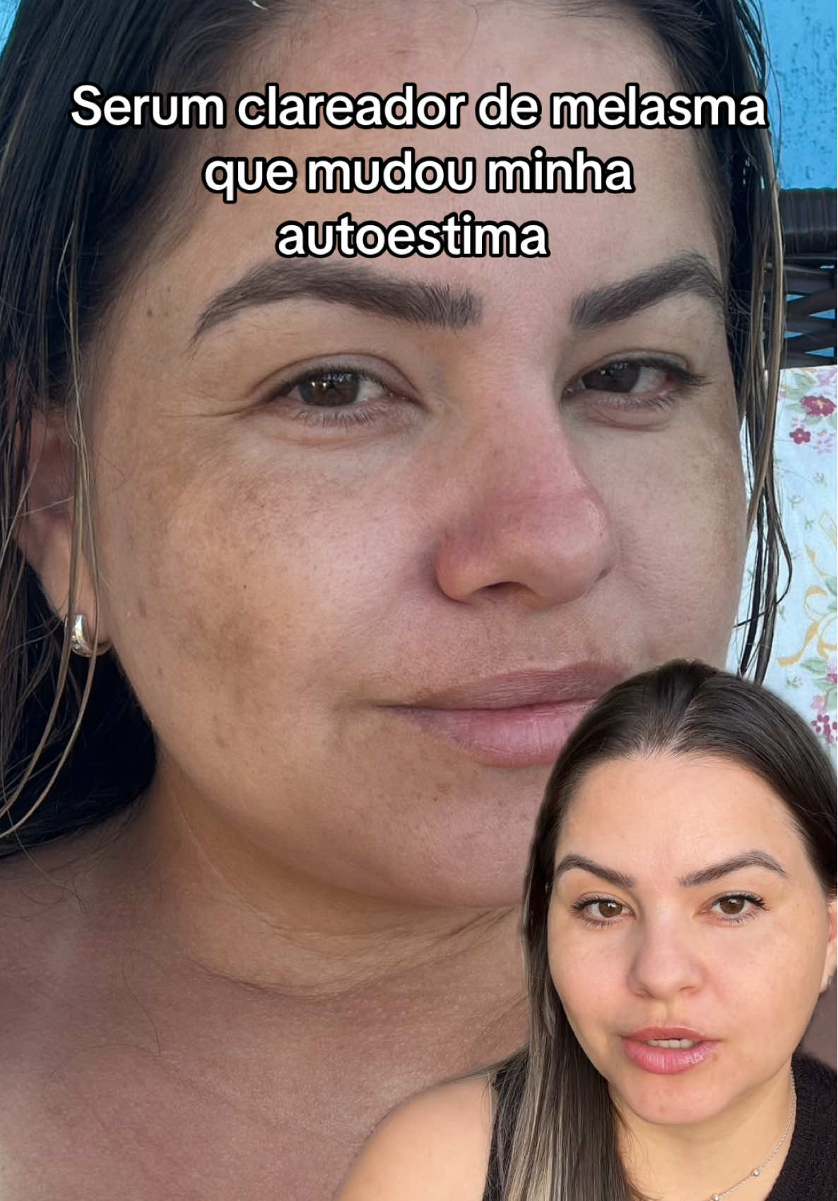 Esse serum mudou meu rosto, minha autoestima! Agora vivo sem Make tranquila! #serumclareador #serum #melasma #manchasnapele #manchasescurasnorosto 
