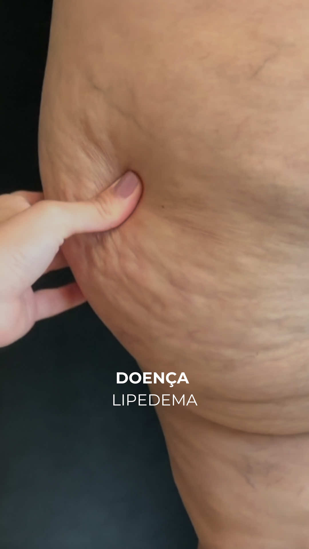 Você sabia que a gordura do Lipedema é diferente da gordura comum? Ela é doente, dolorosa, resistente a dieta e exercício. Por isso, o tratamento cirúrgico e conservador é 360°, cuidando de você em todos aspectos. Na cirurgia do Lipedema, usamos tecnologias que ajudam não apenas a remover a gordura doente, mas também a retrair a pele.  Isso significa: • Melhor resultado estético • Menos flacidez • Mais conforto para a paciente Cuidar do Lipedema é devolver sua qualidade de vida. 📌 Tem dúvidas sobre a doença LIPEDEMA ? Envie nos comentários 👇🏻 #lipedema #lipedemabh #lipedemabrasil #dralauraviterbo #cirurgiaplástica 