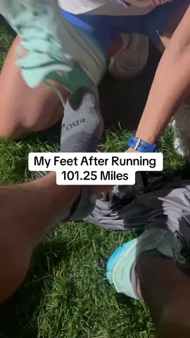 How my feet look after a 100 mile race #Fitness #Running #fyp 