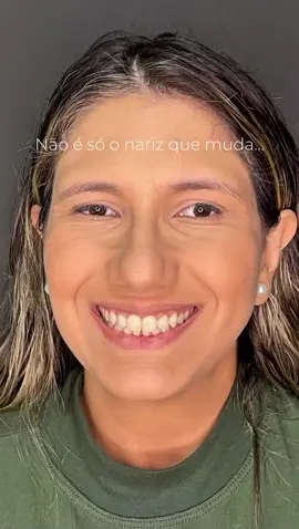 PÓS-OPERATÓRIO – 3 MESES ✨ Um nariz mais leve, harmonioso e com um toque de rejuvenescimento. ⠀ Em apenas 3 meses, já conseguimos ver a diferença: o inchaço diminui, os contornos ficam mais definidos e o resultado começa a revelar toda sua beleza. 👨🏻‍🎨💎 ⠀ Essa paciente ficou simplesmente radiante com o novo perfil. E você, o que achou dessa transformação? ### POST-OP – 3 MONTHS ✨ A lighter, more harmonious nose with a touch of rejuvenation. ⠀ In just 3 months, the difference is already noticeable: the swelling has reduced, the contours are more defined, and the result is starting to reveal all its beauty. 👨🏻‍🎨💎 ⠀ This patient was absolutely thrilled with her new profile. What do you think of this transformation? #rinoplastia #transformacaonariz #rhinoplasty #rinoplastiacampinas #rinoplastiabrasil  —- Importante: os resultados apresentados são específicos para este caso e não podem ser generalizados para todos os pacientes. As imagens devem ser consideradas apenas como um ponto de referência. O procedimento cirúrgico carrega riscos e não há garantia de resultados específicos. Publicação de caráter acadêmico demonstrando fotos de antes e depois sem edições, conforme resolução do CFM 2.336/2023