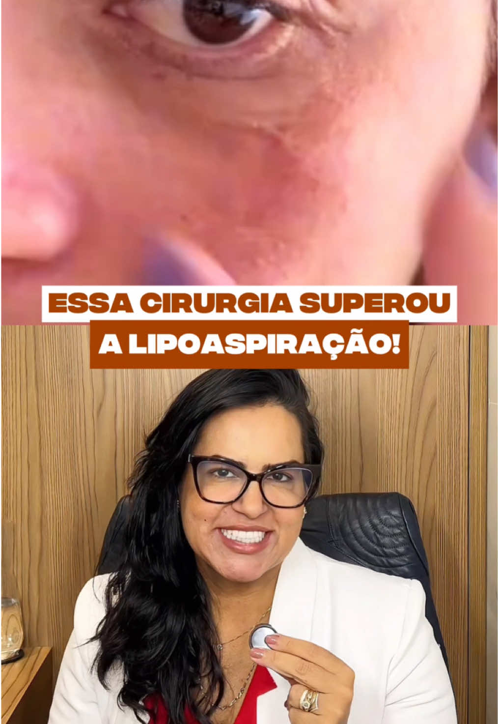 Essa cirurgia superou a lipoaspiração! E não é à toa: ela rejuvenesce o olhar, elimina o excesso de pele das pálpebras e deixa o rosto com um aspecto mais leve e descansado. Mas e quem tem medo de cirurgia? 🤔 Hoje existem alternativas incríveis, sem cortes e sem bisturi, que têm sido chamadas de “blefaroplastia sem cortes” e estão conquistando quem busca rejuvenescimento com segurança e praticidade. 🎥 Assista ao vídeo de hoje e descubra quais são os 3 procedimentos não cirúrgicos que vêm revolucionando o rejuvenescimento do olhar. 👉 Comente “eu quero” aqui embaixo se você quer saber qual deles é ideal para o seu caso e eu te explico tudo nos detalhes! . . . . . . . . . . #clinicavanessacabral #blefaroplastiasemcorte #olharrejuvenescido #semcirurgia #procedimentosesteticos            