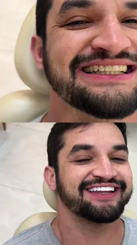 #facetas #lentes #odontologia #facetasemresina 