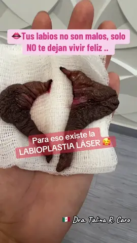Lucia tenía sentía una labios que le causaban dolor, irritación y molestias para su aseo. Ellla dividió terminar sin ese sufrimiento y se hizo una Labioplastia 👄. #labioplastia #labioplastialaser #laserco2  #labioplastiacdmx #labioplasty 