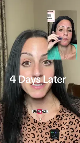 No filter needed✨4 days aftet Qure’s Micro-infusion and my skin looks plump, smooth, and glowing. This at-home treatment helps with wrinkles, dark spots, pores, and collagen production. Grab it now while it’s still on BOGO—4 months of treatments from home! @Qure Skincare  #microinfusionfacial #microneedling #qureskincare #antiaging #athomefacial 