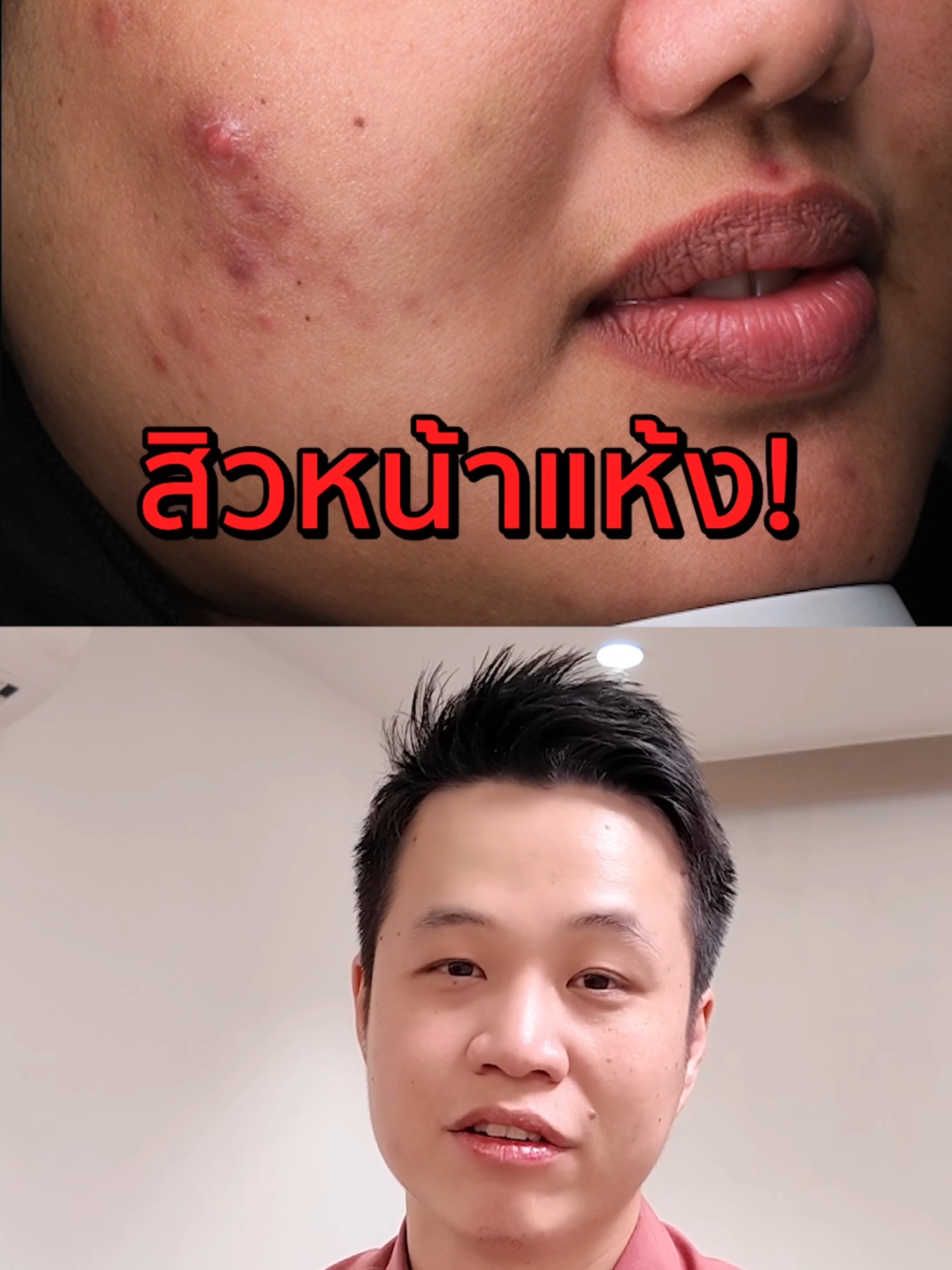 สิวหน้าแห้ง! จริงๆเกิดจากอะไร? ดูคลิปนี้ให้จบนะครับมีประโยชน์มากๆ #สิว #สกินแคร์ #พี่ฝุ่งสอนดูแลผิว #ผิวแห้ง