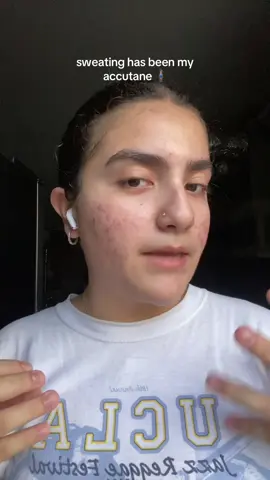 should’ve been consistent with running a long time ago 😭 #acne #acneskin #acnejourney #accutane 