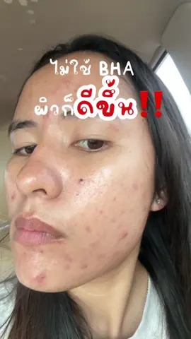 เหนือกว่า BHA ต้องยกให้เขา  #SEBOโซ๊ะสิว #โซ๊ะวงจรสิว #YvesRocher #อีฟโรเช