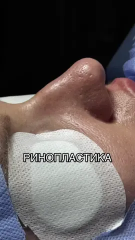 #ринопластика#київ