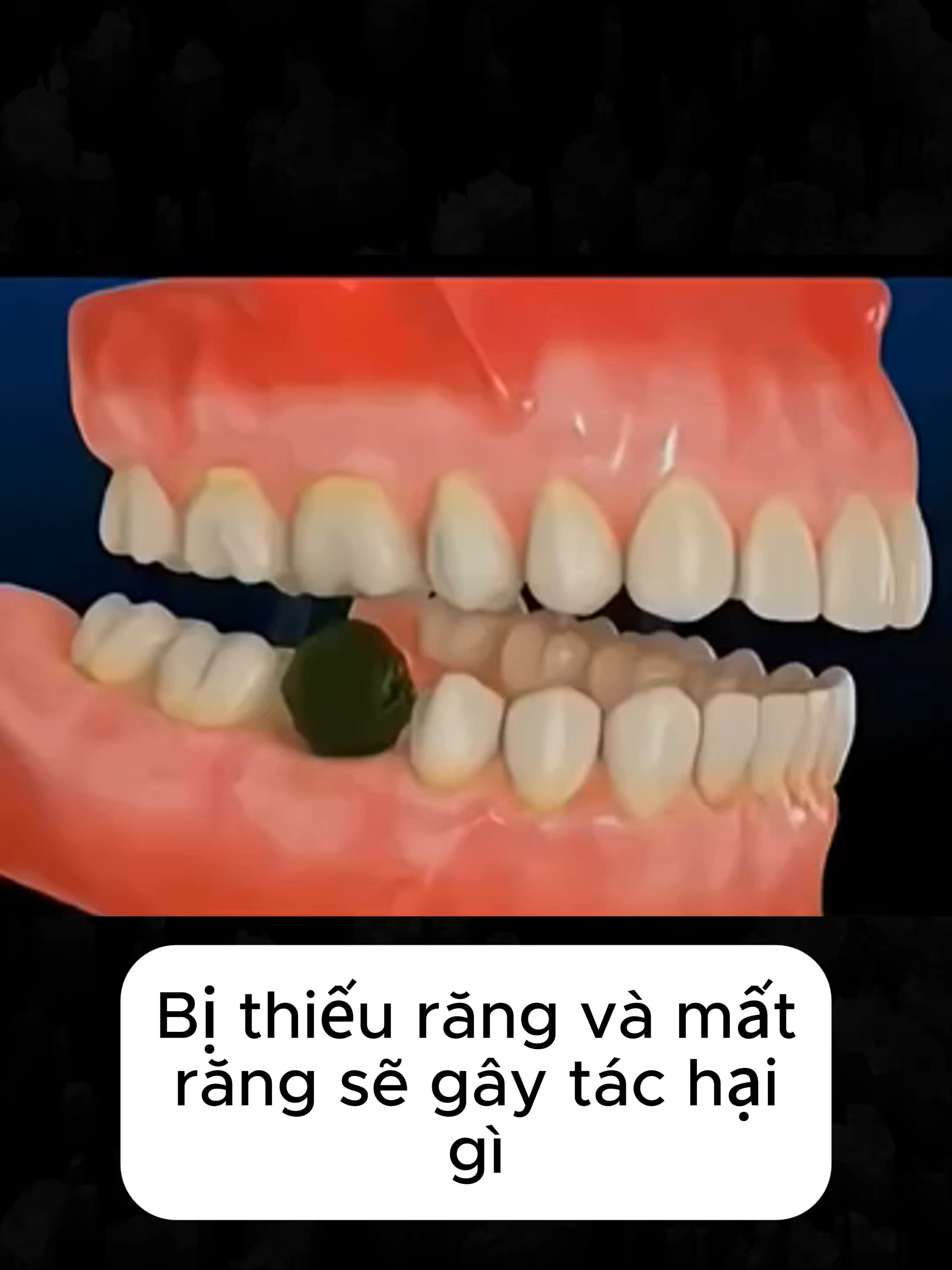 bị thiếu răng #nhakhoaquocteminhduc#thieurang#viral#toptrending