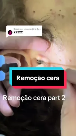 Respondendo a @⛦ #pimple #viral #fly #satisfatório #asmr 