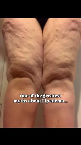 I always look back and think.. what if I hadn’t kept going in the gym? There was a point where my legs hadn’t improved at all, even after losing a massive amount of weight, and the only information available said that Lipedema was “resistant to diet and exercise” So I pushed harder. I still remember those “five-mile Saturdays,” forcing myself to run and trying to beat my time, even though every step felt weighed down by the fat on the back of my legs. What I didn’t realize then was that exercise wasn’t failing me, I just needed to approach it differently. At Stage 3, my biggest focus had to be on losing the normal fat. At Stage 2, I still had to keep losing fat, but I also began slowly building strength and improving mobility through strength training. Now, at Stage 1, the focus is full-on muscle building,  and that’s what’s changing everything. This workout is a Phase 2–3 style routine. If you’re at Phase 3, it’s all-in with kettlebell strength. If you’re at Phase 2, you can modify as you build. Either way, it meets you where you are. My Lipedema Workout Blueprint lays it all out by stage and phase and will soon pair with my mobile app coming this fall!  You can find my Blueprint linked right in my bio! 🤍🤍 Don’t forget to have fun with this one! 😘💪🏻#lipedema #lipedemafitness #lipedemamovementandfitness #lipedemaexercise #lipedemafitness 