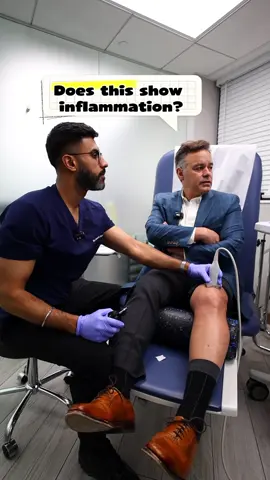 How to get rid of knee pain? Steroid injections are a trusted option for managing knee pain caused by inflammation or arthritis. By delivering medication directly into the joint, they help reduce swelling, pressure, and pain while improving movement. Many patients find that injections make it easier to return to daily activities, exercise, and physical therapy—without relying on long-term pain medications or surgery. #kneepain #painrelief #painmanagement 