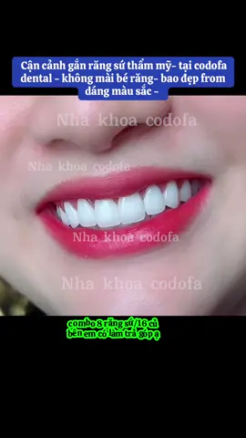 Cận cảnh gắn răng sứ thẩm mỹ- tại codofa dental - không mài bé răng- bao đẹp from dáng màu sắc -  #nhakhoacodofa #dánsứveneer #răng_sứ_thẩm_mỹ #khôngmài_nhỏ_răng #làm_răng_sứ_trả_góp 