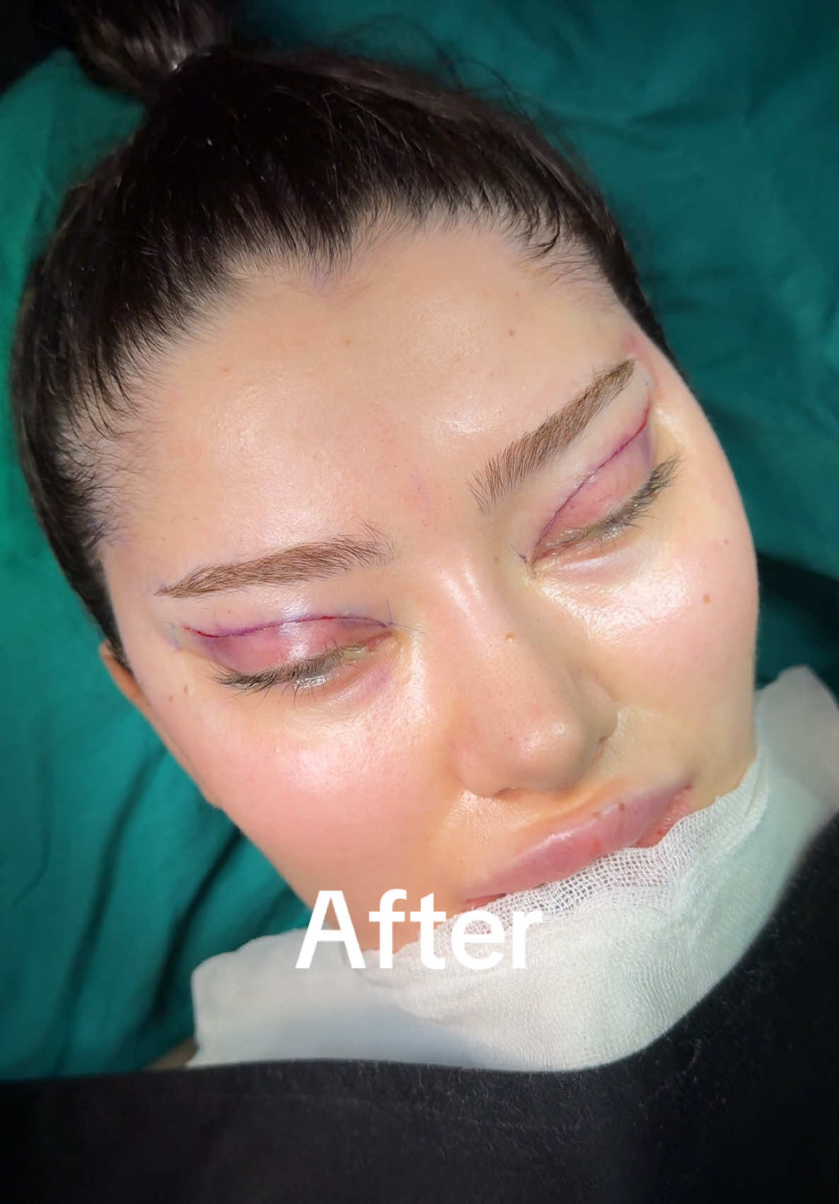 Cateyes surgery with upper blepharoplasty 👏👏👏 #princessnose #foxeyessurgery #facelifting #temporallift #endoscopicfacelift 