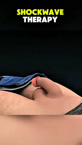Shockwave therapy 3d animations. #shockwavetherapy #medicalanimation #healtheducation #healthawareness 