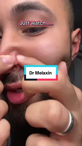 Dr Melaxin Korean Skin Peel Shot ! #drmelaxin#kbeauty#koreanskinpeel 