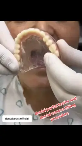 #denture #teeths #dental #full #implants #crowns #foryoupage❤️❤️ 