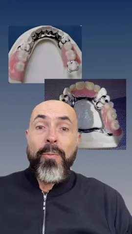🔹 Prótese Parcial Removível Tipo Roach A Prótese Parcial Removível tipo Roach é uma solução clássica, segura e eficiente para substituir dentes ausentes quando não há indicação ou desejo de realizar implantes ou próteses fixas. ✔️ Conforto e estabilidade – graças à sua estrutura metálica precisa, oferece ótima retenção e adaptação. ✔️ Preservação da saúde bucal – mantém a distribuição equilibrada da mastigação, ajudando a proteger dentes e gengivas. ✔️ Estética discreta – confeccionada de forma personalizada para harmonizar com seu sorriso. ✔️ Custo-benefício imbatível – ainda é a opção mais acessível e funcional para devolver a mastigação e a estética em casos selecionados. ➡️ Mesmo com todos os avanços da odontologia, a prótese Roach continua sendo a melhor alternativa quando não optamos por implantes ou pontes fixas – reunindo tradição, eficiência e confiabilidade no tratamento.