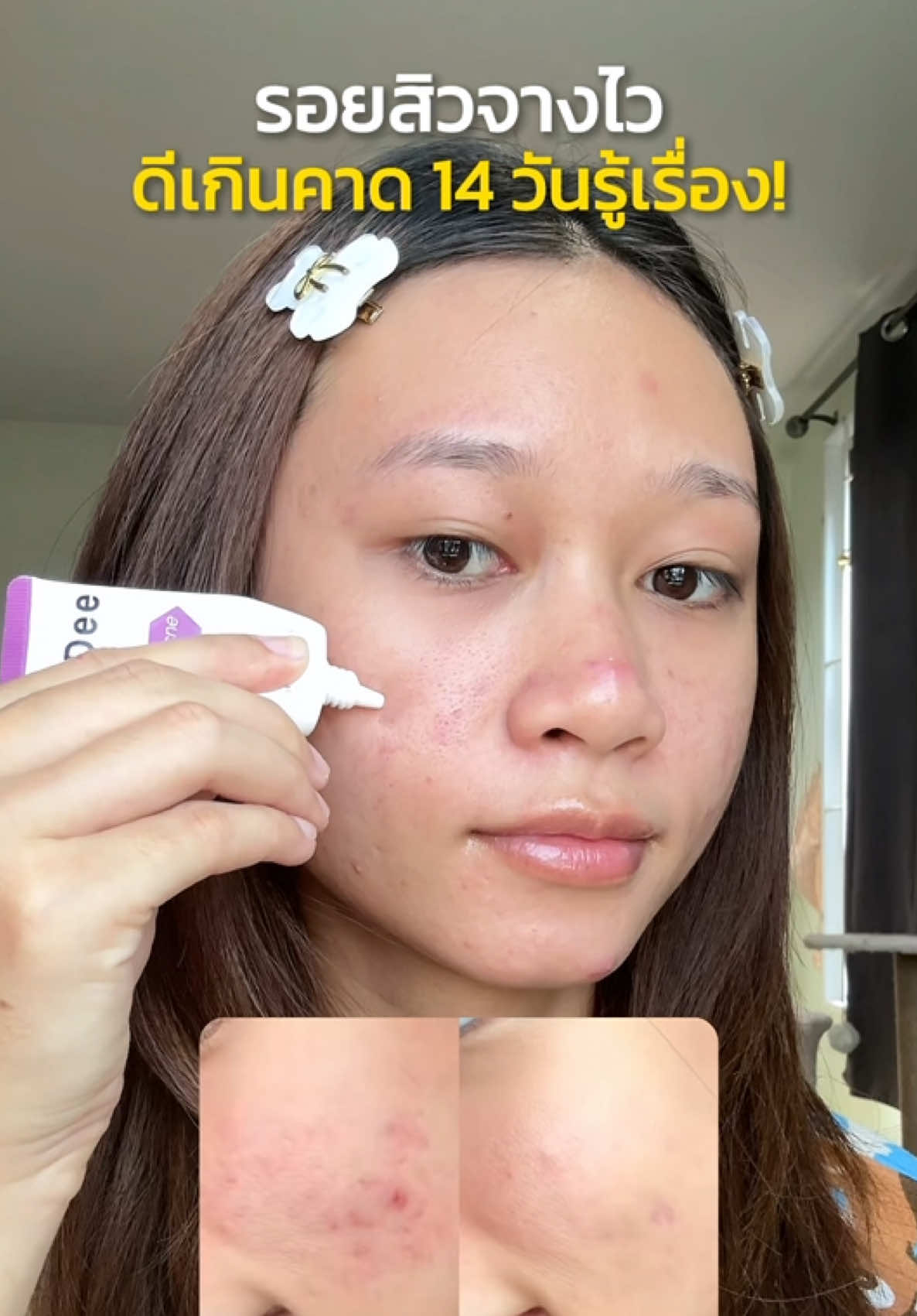 ตอบกลับ @karakat_kate รอยสิวจางไว ดีเกินคาด 14 วันรู้เรื่อง! @D.Dee Official #เจลรอยสิว #DDee #รอยสิว #รีวิวDDee #เจลน้องม่วง #รอยสิว #ผักบุ้งก้านยาว 