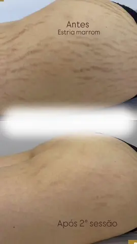 ESTRIAS MARRONS!! RESULTADOS APÓS 2° SESSÃO!! ✨✨ AQUI OS RESULTADOS SÃO REAIS💎 MICRODERME TRANSFORMANDO VIDAS!! ❤️ Agende já sua avaliação gratuita 👇👇 📲CHAMA NO DIRECT  #microderme #tratamentodefinitivo #autoconfiança #tratamentodeestrias #estriasnuncamais #autoestima #belezanatural #adeusestrias #obiquinivem #viralpost2025