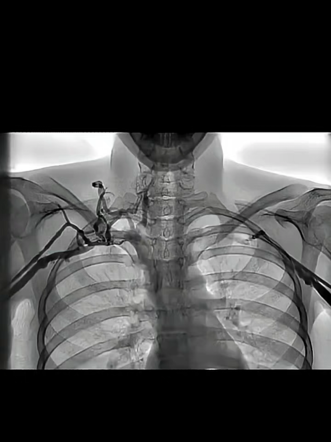 This incredible venogram (an X-ray of the veins using contrast dye) provides a clear look at a fascinating anatomical phenomenon. As the arms are raised, watch how the subclavian vein gets compressed in the narrow space between the collarbone (clavicle) and the first rib. ​This 