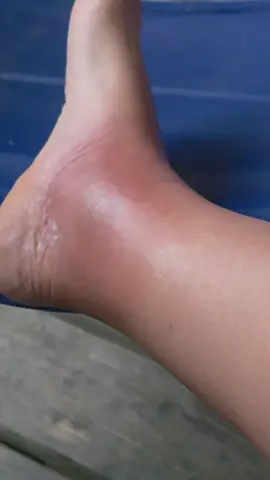 it's not getting any better. I sat around all day yesterday with putting ice and oinmnet on it. I elevated my foot amd took benadryl I actually think it got worse. It itches so it woke me up. Hoping these steroids and new cream the dr prescribed will take care of. #sahm #momover35 #beesting #friday #whyme 