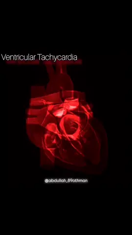 AFib vs. VFib: Critical Heart Rhythms Explained! 📽️ @abdullah_89othman Curious about how these life-threatening heart rhythms differ? Let’s break it down: 🔍 Key Differences: Atrial Fibrillation (AFib): Irregular, chaotic rhythm in the atria (upper chambers). Heartbeats are erratic. Ventricular Tachycardia (VT): Fast, regular rhythm from the ventricles (lower chambers). Can lead to... Ventricular Fibrillation (VFib): Deadly, disorganized ventricular rhythm. The heart quivers, unable to pump blood. ⚠️ AFib may increase the risk of ventricular arrhythmias. Watch the video to see these rhythms in action! 👇 #HeartHealth #Cardiology #ECG #AFib #VTach 