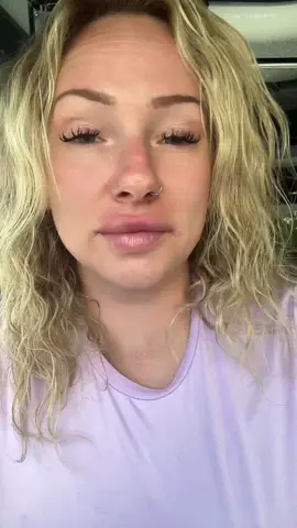 Progress of having my lips dissolved with @Mr.injectable at Jewel Medical Spa in Naples, FL. #lipfiller #dissolvedfiller #medspa #filler #florida 