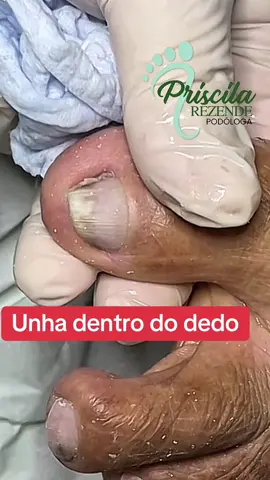 Unha dentro do dedo #unha #unhas #nail #dedo #dedos 