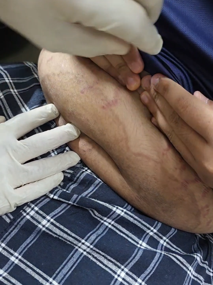 #tinea #kurap #eczema #klinikabdulrahim #drrahim 