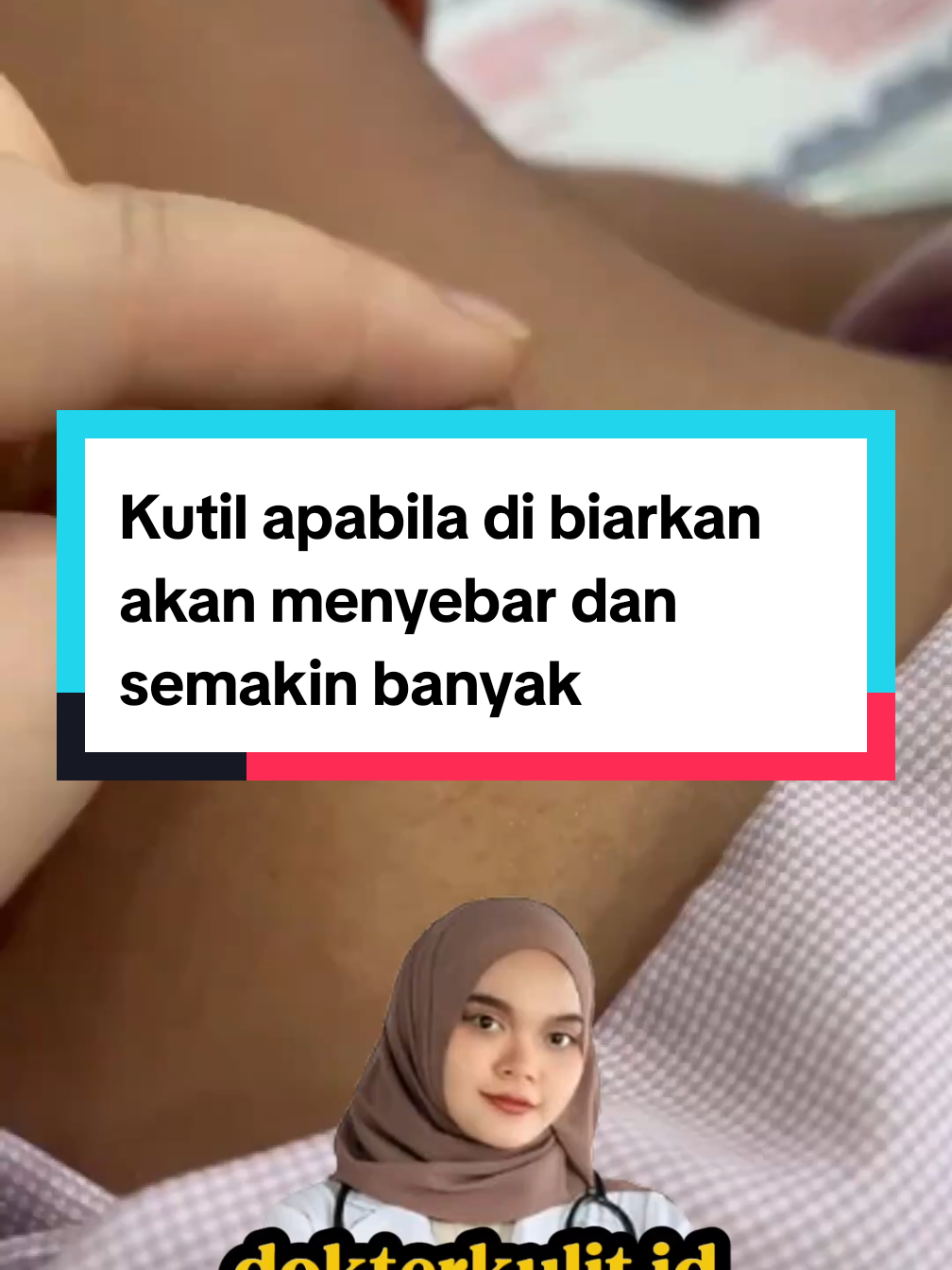 Kutil apabila di biarkan akan menyebar dan semakin banyak.  #kutil #penghilangkutil #penghilangtahilalat #swissparislotionoriginal 