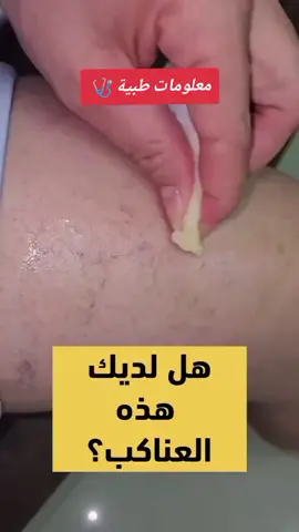 #دوالي #الاجرين #ساقين #دوالي_الساقين #وصفة #وصفة_سهلة #علاج_طبيعي #علاج #معالج #shaman #عام #جميع #عظام_ومفاصل #جلد #جلدية #اوعية_دموية #