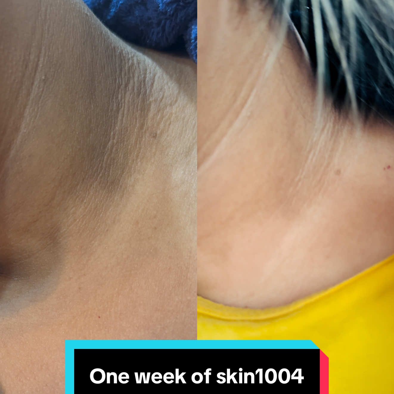 Retinol for dark neck- SKIN1004 Madagascar Centella Retinol 0.2 Boosting Shot Ampoule 30ml  for rescue  @SKIN1004 US @BAZZAAL  #skin1004 #spiculeampoule #skin1004retinol #darkneck #koreanskincare  . . . . . . . . . . . . The dark neck could also be beacuse of medical condition, so consult expert if required.