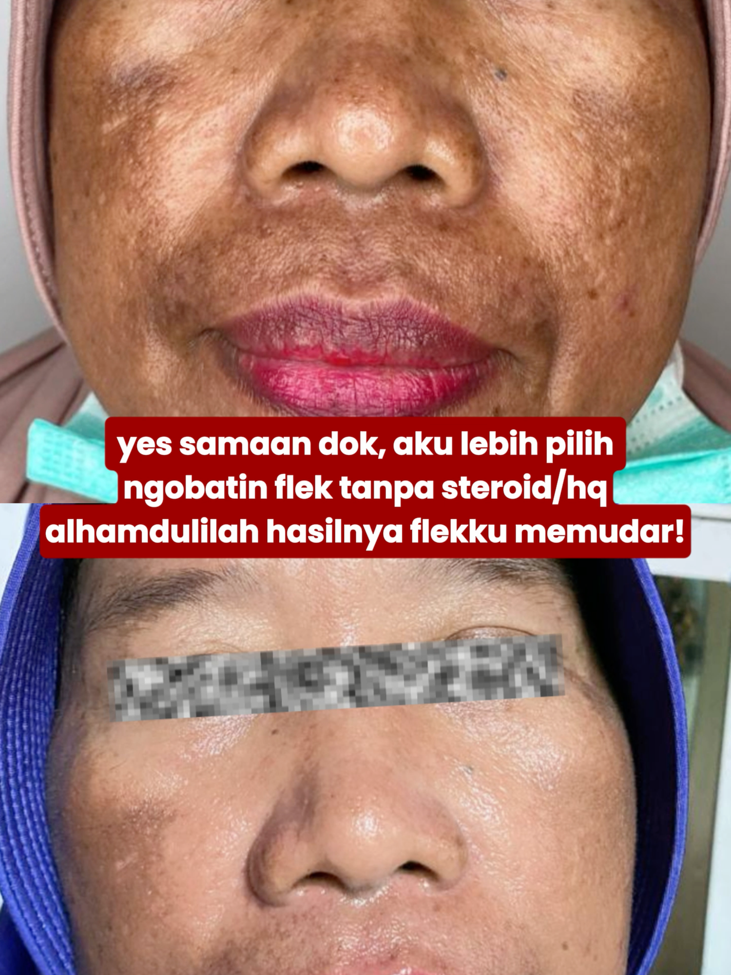 Melasma Kit CH DERMACLICK by dr.anisa — satu satunya skincare melasma di indonesia tanpa membuat ketergantungan! #skincareroutine #skincaretips #foryoupage