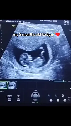 2 Months Old Ultrasound  #baby #babylove #ultrasound #babylove #viral 