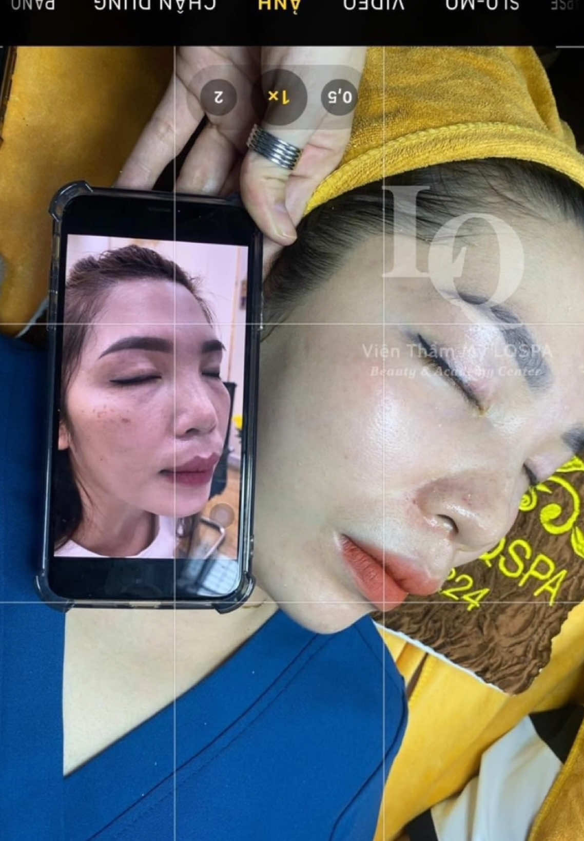 Cập nhật da nám #chamsocdamun#chamsocdaseo#chamsocdanam#tanbinh#govap       