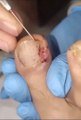 搞定甲沟炎#Singapore #新加坡 #热门 #paronychia #海外生活 