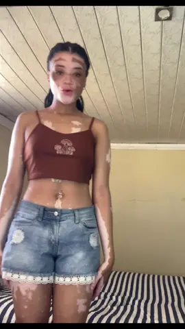 Need more tattoos 🤭 #girlwiththetattoo #fyp #foryoupage❤️❤️ #vitiligobeauty 