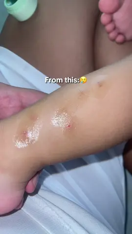 Stress talaga ako dahil ang panget na ng binti ni uno sa kakakamot niya twing may kagat na lamok o insecto buti nalang meron itong heger balm😭❤️ #hegerbaby #insectbites 