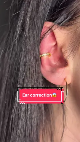 #correctoresdeorejas#CorrectEarCo##otoplastia 
