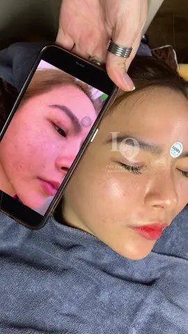 Cập nhật da nám  #chamsocdaseo#chamsocda#chamsocdamun#chamsocdanam#tanbinh   #    